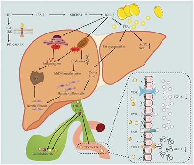 A review of MASLD-related hepatocellular carcinoma: progress in pathogenesis, early detection, and therapeutic interventions